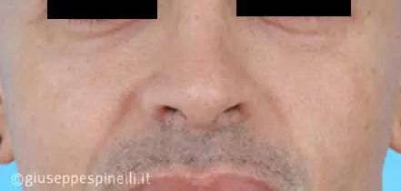 Rinoplastica foto dopo l'intervento, risultato di rinoplastica funzionale ricostruttiva per deficit di ventilazione da asimmetria della valvola nasale sinistra, Dott. Giuseppe Spinelli