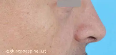 Rinoplastica foto dopo l'intervento, risultato di rinoplastica funzionale ricostruttiva per deficit di ventilazione da asimmetria della valvola nasale sinistra, Dott. Giuseppe Spinelli
