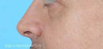 Rinoplastica foto dopo l'intervento, risultato di rinoplastica funzionale ricostruttiva per deficit di ventilazione da asimmetria della valvola nasale sinistra, Dott. Giuseppe Spinelli