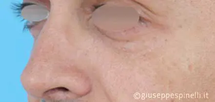 Rinoplastica foto dopo l'intervento, risultato di rinoplastica funzionale ricostruttiva per deficit di ventilazione da asimmetria della valvola nasale sinistra, Dott. Giuseppe Spinelli