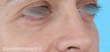 Rinoplastica foto dopo l'intervento, risultato di rinoplastica funzionale ricostruttiva per deficit di ventilazione da asimmetria della valvola nasale sinistra, Dott. Giuseppe Spinelli