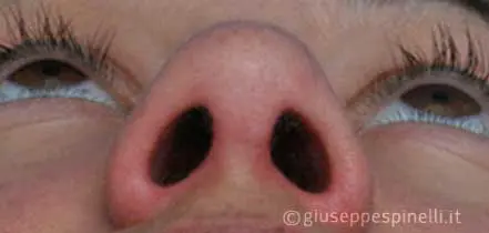 Rinoplastica foto dopo l'intervento, risultato di rinoplastica secondaria con ripristino della pervietà delle fosse nasali e tecnica di alar contouring, Dott. Giuseppe Spinelli