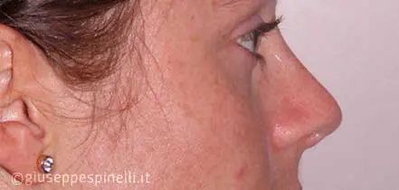 Rinoplastica foto dopo l'intervento, risultato di rinoplastica secondaria con ripristino della pervietà delle fosse nasali e tecnica di alar contouring, Dott. Giuseppe Spinelli