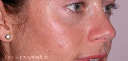 Rinoplastica foto dopo l'intervento, risultato di rinoplastica secondaria con ripristino della pervietà delle fosse nasali e tecnica di alar contouring, Dott. Giuseppe Spinelli