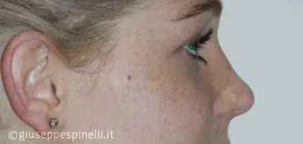Rinoplastica foto dopo l'intervento, risultato di rinoplastica con correzione del dorso nasale e miglioramento della proiezione della punta, Dott. Giuseppe Spinelli