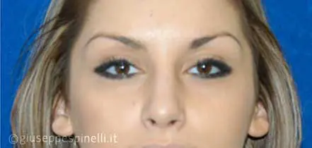Rinoplastica foto dopo l'intervento, risultato di rinoplastica di revisione del dorso nasale e riduzione della punta globosa, Dott. Giuseppe Spinelli