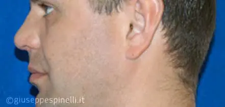 Rinoplastica foto dopo l'intervento, risultato di rinoplastica post traumatica con ricostruzione del difetto tramite innesto cartilagineo autologo, Dott. Giuseppe Spinelli