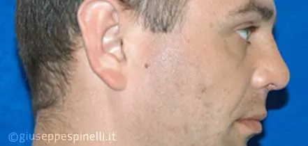 Rinoplastica foto dopo l'intervento, risultato di rinoplastica post traumatica con ricostruzione del difetto tramite innesto cartilagineo autologo, Dott. Giuseppe Spinelli