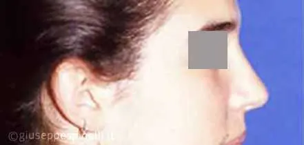 Rinoplastica foto dopo l'intervento, risultato di settorinoplastica di correzione del dorso nasale osseo e del setto cartilagineo con tecnica di quilting suture, Dott. Giuseppe Spinelli