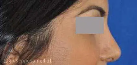Rinoplastica foto dopo l'intervento, risultato di rinoplastica per riduzione della punta nasale, Dott. Giuseppe Spinelli