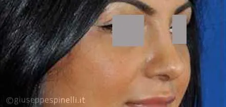 Rinoplastica foto dopo l'intervento, risultato di rinoplastica della punta nasale larga con tecnica alar wedge incision per ridurre le narici, Dott. Giuseppe Spinelli