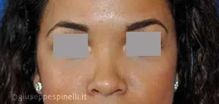 Rinoplastica foto dopo l'intervento, risultato di rinoplastica della punta nasale larga con tecnica alar wedge incision per ridurre le narici, Dott. Giuseppe Spinelli