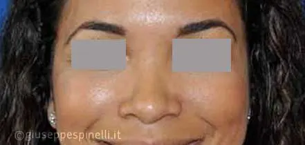 Rinoplastica foto dopo l'intervento, risultato di rinoplastica della punta nasale larga con tecnica alar wedge incision per ridurre le narici, Dott. Giuseppe Spinelli