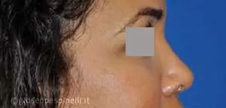 Rinoplastica foto dopo l'intervento, risultato di rinoplastica della punta nasale larga con tecnica alar wedge incision per ridurre le narici, Dott. Giuseppe Spinelli