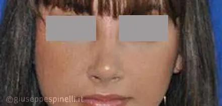 Rinoplastica foto dopo l'intervento, risultato di settorinoplastica primaria per deformità del dorso e della punta nasale, Dott. Giuseppe Spinelli