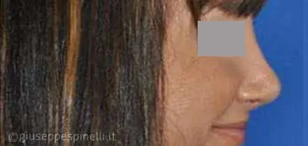 Rinoplastica foto dopo l'intervento, risultato di settorinoplastica primaria per deformità del dorso e della punta nasale, Dott. Giuseppe Spinelli