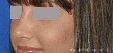 Rinoplastica foto dopo l'intervento, risultato di settorinoplastica primaria per deformità del dorso e della punta nasale, Dott. Giuseppe Spinelli