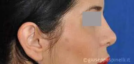 Rinoplastica foto dopo l'intervento, risultato di rinoplastica con correzione del deficit della valvola sinistra tramite spreader graft autologo, Dott. Giuseppe Spinelli