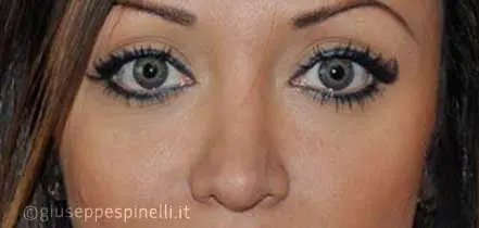 Rinoplastica foto prima dell'intervento, caso di settorinoplastica con riduzione del dorso cartilagineo, sutura delle crus laterali alari e innesto columellare autologo, Dott. Giuseppe Spinelli