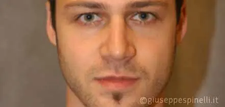 Rinoplastica foto dopo l'intervento, risultato di settorinoplastica primaria per deformità del dorso, Dott. Giuseppe Spinelli