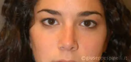 Rinoplastica foto dopo l'intervento, risultato di settorinoplastica con riduzione del dorso cartilagineo, sutura delle crus laterali alari e innesto columellare autologo, Dott. Giuseppe Spinelli