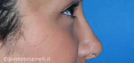 Rinoplastica foto dopo l'intervento, risultato di settorinoplastica post traumatica con riposizionamento del dorso nasale e sutura della punta, Dott. Giuseppe Spinelli