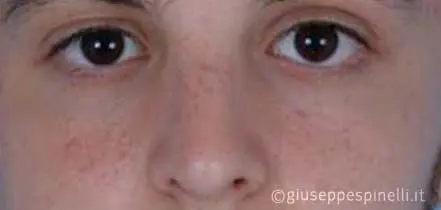 Rinoplastica foto dopo l'intervento, risultato di settorinoplastica post traumatica con riposizionamento del dorso nasale e sutura della punta, Dott. Giuseppe Spinelli
