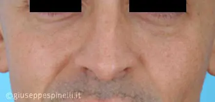 Rinoplastica foto prima dell'intervento, caso di rinoplastica funzionale ricostruttiva per deficit di ventilazione da asimmetria della valvola nasale sinistra, Dott. Giuseppe Spinelli