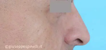 Rinoplastica foto prima dell'intervento, caso di rinoplastica funzionale ricostruttiva per deficit di ventilazione da asimmetria della valvola nasale sinistra, Dott. Giuseppe Spinelli