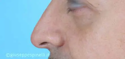 Rinoplastica foto prima dell'intervento, caso di rinoplastica funzionale ricostruttiva per deficit di ventilazione da asimmetria della valvola nasale sinistra, Dott. Giuseppe Spinelli