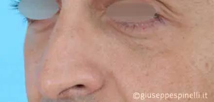 Rinoplastica foto prima dell'intervento, caso di rinoplastica funzionale ricostruttiva per deficit di ventilazione da asimmetria della valvola nasale sinistra, Dott. Giuseppe Spinelli