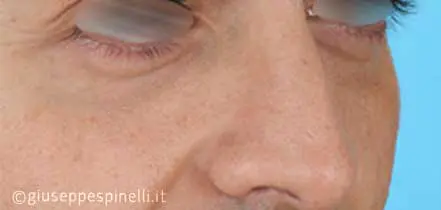 Rinoplastica foto prima dell'intervento, caso di rinoplastica funzionale ricostruttiva per deficit di ventilazione da asimmetria della valvola nasale sinistra, Dott. Giuseppe Spinelli