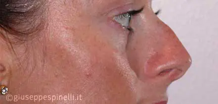 Rinoplastica foto prima dell'intervento, caso di rinoplastica secondaria con ripristino della pervietà delle fosse nasali e tecnica di alar contouring, Dott. Giuseppe Spinelli