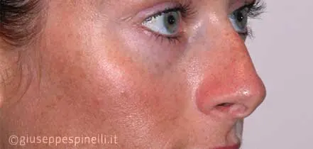 Rinoplastica foto prima dell'intervento, caso di rinoplastica secondaria con ripristino della pervietà delle fosse nasali e tecnica di alar contouring, Dott. Giuseppe Spinelli
