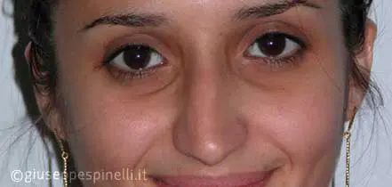 Rinoplastica foto prima dell'intervento, caso di rinoplastica post traumatica, Dott. Giuseppe Spinelli