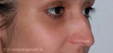 Rinoplastica foto prima dell'intervento, caso di rinoplastica post traumatica, Dott. Giuseppe Spinelli