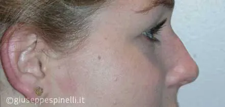 Rinoplastica foto prima dell'intervento, caso di rinoplastica con correzione del dorso nasale e miglioramento della proiezione della punta, Dott. Giuseppe Spinelli