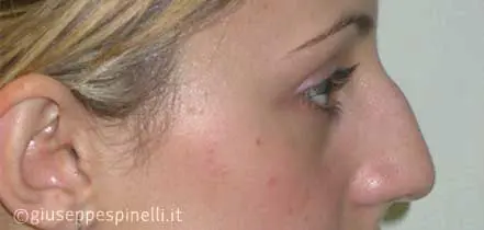 Rinoplastica foto prima dell'intervento, caso di correzione di naso aquilino, Dott. Giuseppe Spinelli