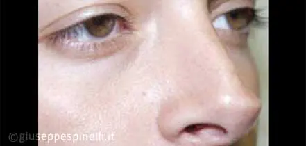 Rinoplastica foto prima dell'intervento, caso di rinoplastica con tecnica di sutura interdomale per migliorare la proiezione della punta nasale, Dott. Giuseppe Spinelli
