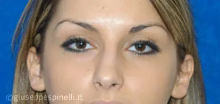 Rinoplastica foto prima dell'intervento, caso di rinoplastica di revisione del dorso nasale e riduzione della punta globosa, Dott. Giuseppe Spinelli