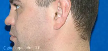 Rinoplastica foto prima dell'intervento, caso di rinoplastica post traumatica con ricostruzione del difetto tramite innesto cartilagineo autologo, Dott. Giuseppe Spinelli