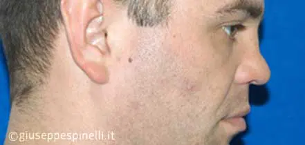 Rinoplastica foto prima dell'intervento, caso di rinoplastica post traumatica con ricostruzione del difetto tramite innesto cartilagineo autologo, Dott. Giuseppe Spinelli