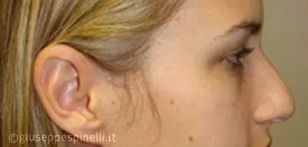 Rinoplastica foto prima dell'intervento, caso di rinoplastica con riduzione del gibbo dorsale e proiezione della punta con innesto columellare autologo, Dott. Giuseppe Spinelli