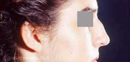 Rinoplastica foto prima dell'intervento, caso di settorinoplastica di correzione del dorso nasale osseo e del setto cartilagineo con tecnica di quilting suture, Dott. Giuseppe Spinell