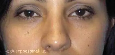 Rinoplastica foto prima dell'intervento, caso di rinoplastica riduttiva con correzione del dorso osseo cartilagineo, deviazione del setto e riduzione della punta globosa, Dott. Giuseppe Spinelli