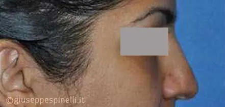 Rinoplastica foto prima dell'intervento, caso di rinoplastica per riduzione della punta nasale, Dott. Giuseppe Spinelli