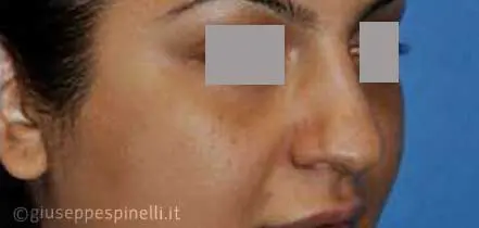 Rinoplastica foto prima dell'intervento, caso di rinoplastica della punta nasale larga con tecnica alar wedge incision per ridurre le narici, Dott. Giuseppe Spinelli