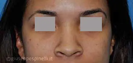 Rinoplastica foto prima dell'intervento, caso di rinoplastica della punta nasale larga con tecnica alar wedge incision per ridurre le narici, Dott. Giuseppe Spinelli