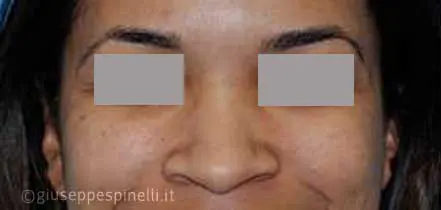 Rinoplastica foto prima dell'intervento, caso di rinoplastica della punta nasale larga con tecnica alar wedge incision per ridurre le narici, Dott. Giuseppe Spinelli