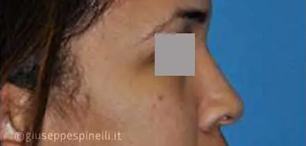 Rinoplastica foto prima dell'intervento, caso di rinoplastica della punta nasale larga con tecnica alar wedge incision per ridurre le narici, Dott. Giuseppe Spinelli